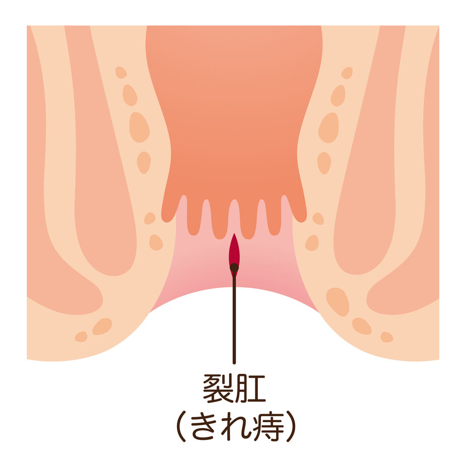 裂肛（切れ痔）｜盛岡市