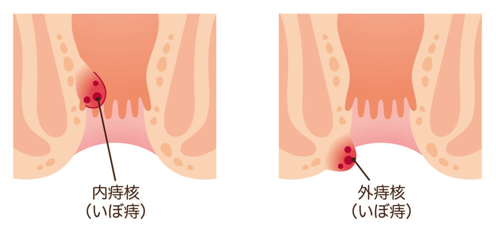 いぼ痔｜盛岡市